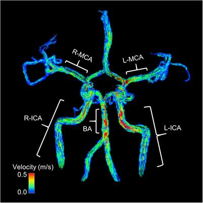 Age-Related Reductions in Cerebrovascular Reactivity Using 4D Flow MRI